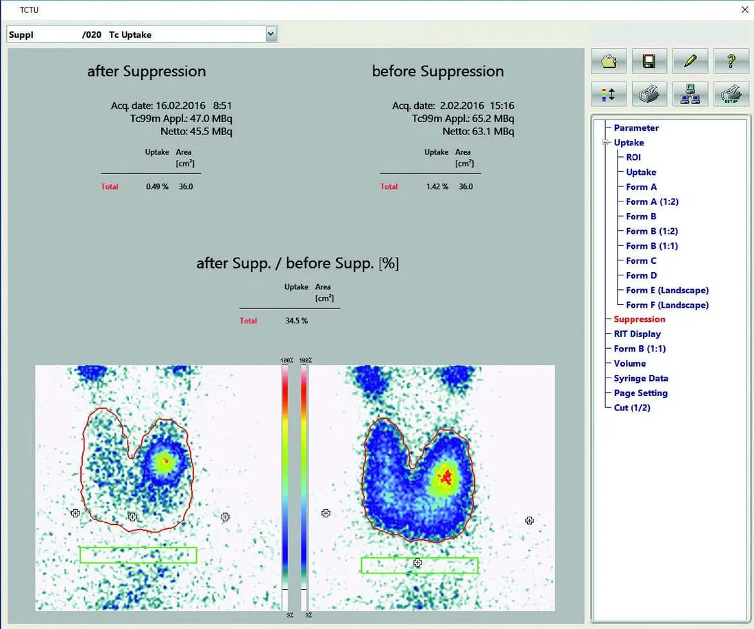 Analysis of Suppression