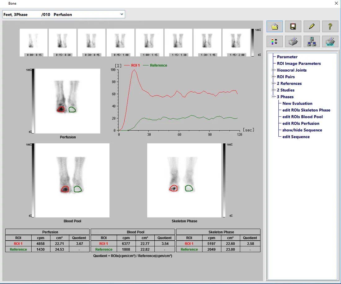 Bone - 3 Phase Scintigraphy