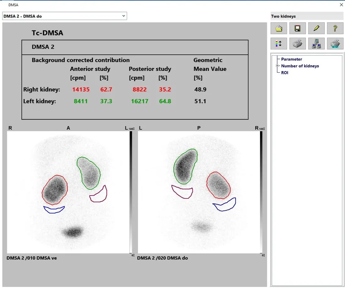 Kidney - DMSA Scintigraphy