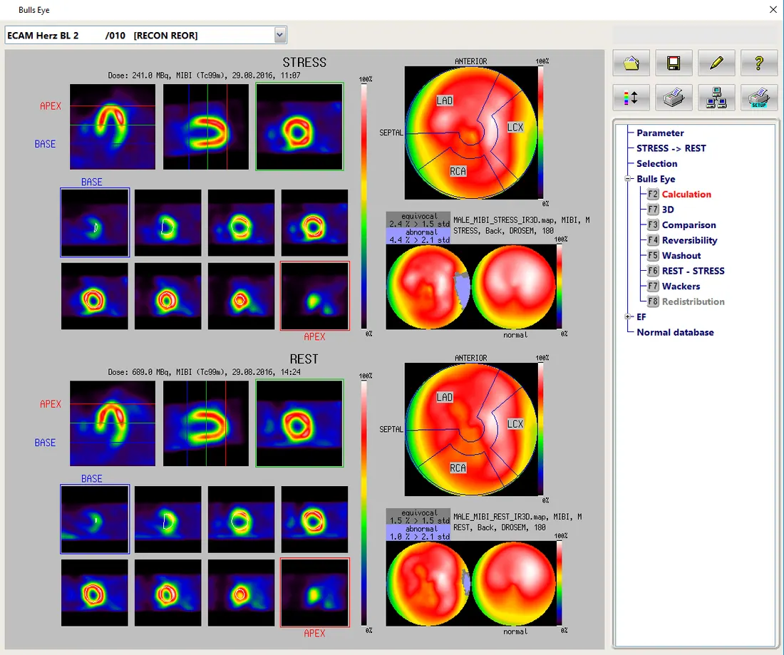 Myocard SPECT